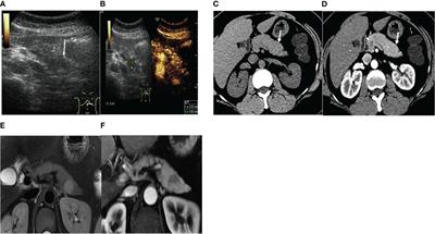 The imaging features of ectopic spleen: which modality is more consistent? A cases series report and literature reviews